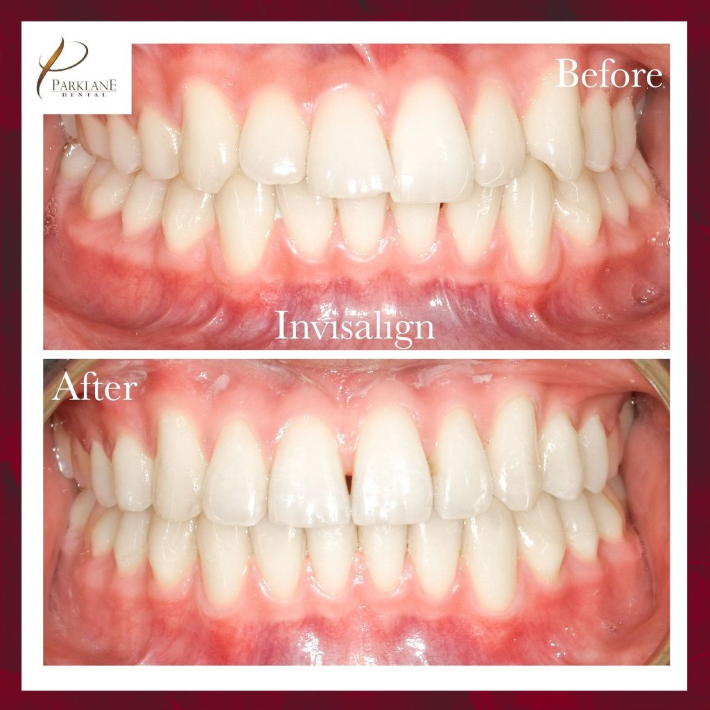 Invisalign Before and After  Dental Treatment Before and After Photos